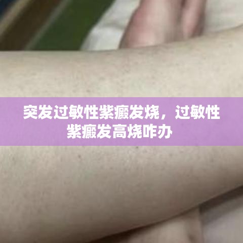 突发过敏性紫癜发烧，过敏性紫癜发高烧咋办 